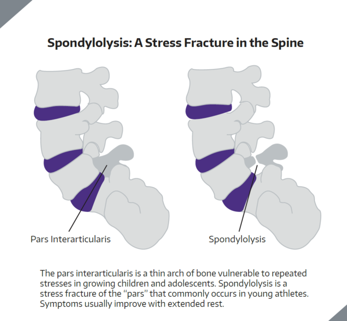 The Sports Institute | When Back Pain Stops a Young Athlete, Think ...